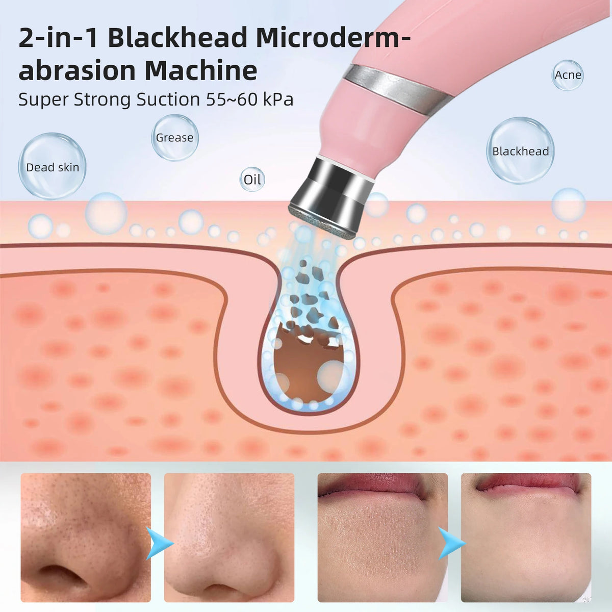 Portable Diamond Microdermabrasion Pen